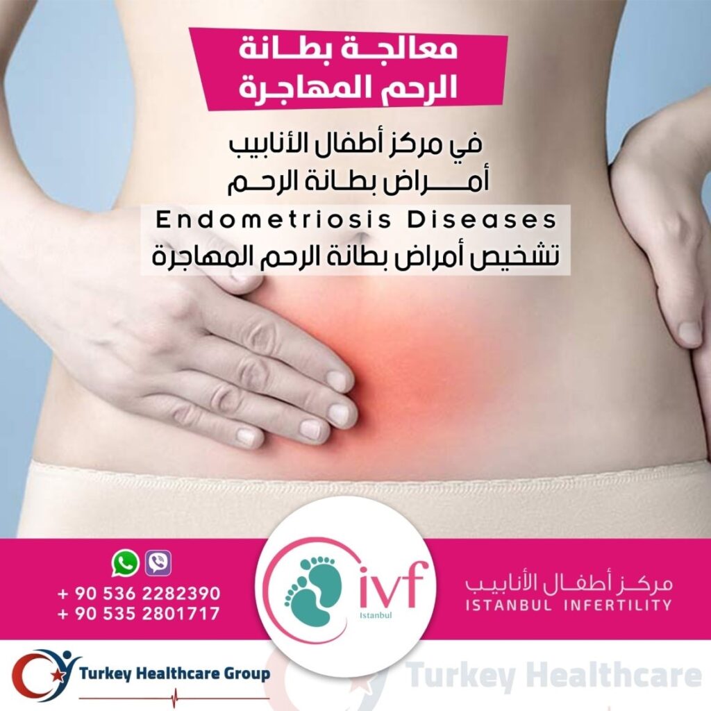 بطانة الرحم المهاجرة